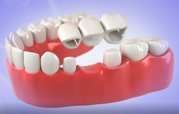 Bridge For Teeth | Crown and Bridge Dentist Kalamazoo, MI | Karen Mitchell Dentistry