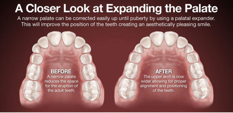 Dental Expander | Orthodontic Dentist Kalamazoo, MI | Karen Mitchell Dentistry